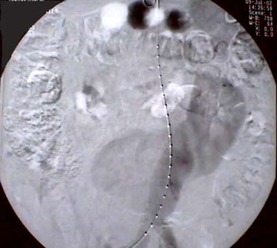 Il s’agit d’un patient de 74 ans qui subit une investigation pour anévrisme de l’aorte abdominale…