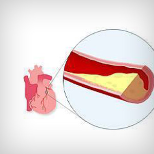 L’hyperlipidémie (Cholestérol et triglycérides)